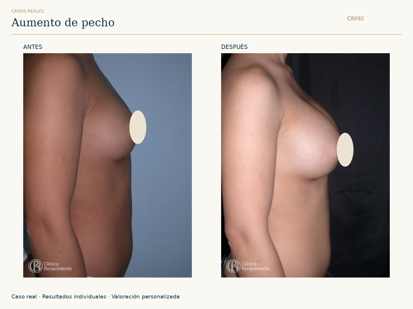Aumento de senos / Mamoplastia de aumento: antes y después, vista perfil derecho. Clínica Renacimiento Marbella.
