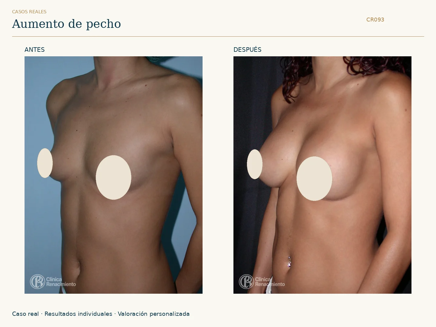 Aumento de senos / Mamoplastia de aumento: antes y después, vista oblicua izquierda. Clínica Renacimiento Marbella.