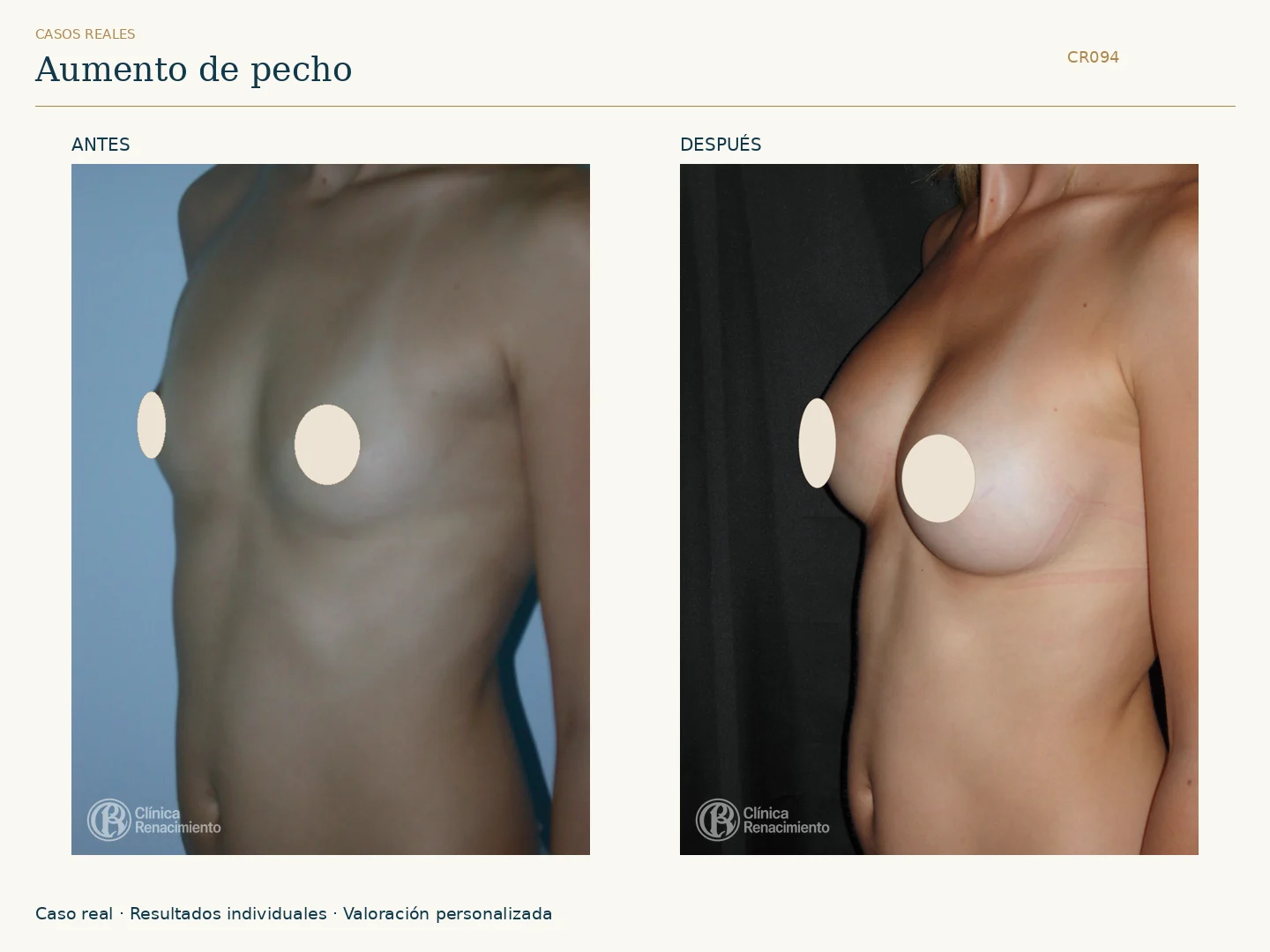 Aumento de senos / Mamoplastia de aumento: antes y después, vista oblicua izquierda. Clínica Renacimiento Marbella.