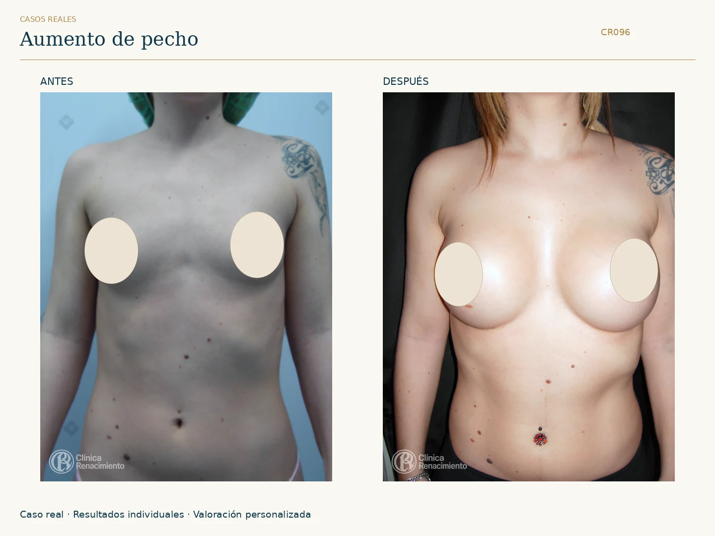 Aumento de senos / Mamoplastia de aumento: antes y después, vista frontal. Clínica Renacimiento Marbella.