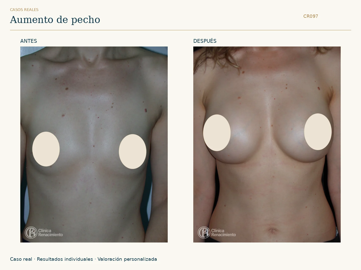 Aumento de senos / Mamoplastia de aumento: antes y después, vista frontal. Clínica Renacimiento Marbella.