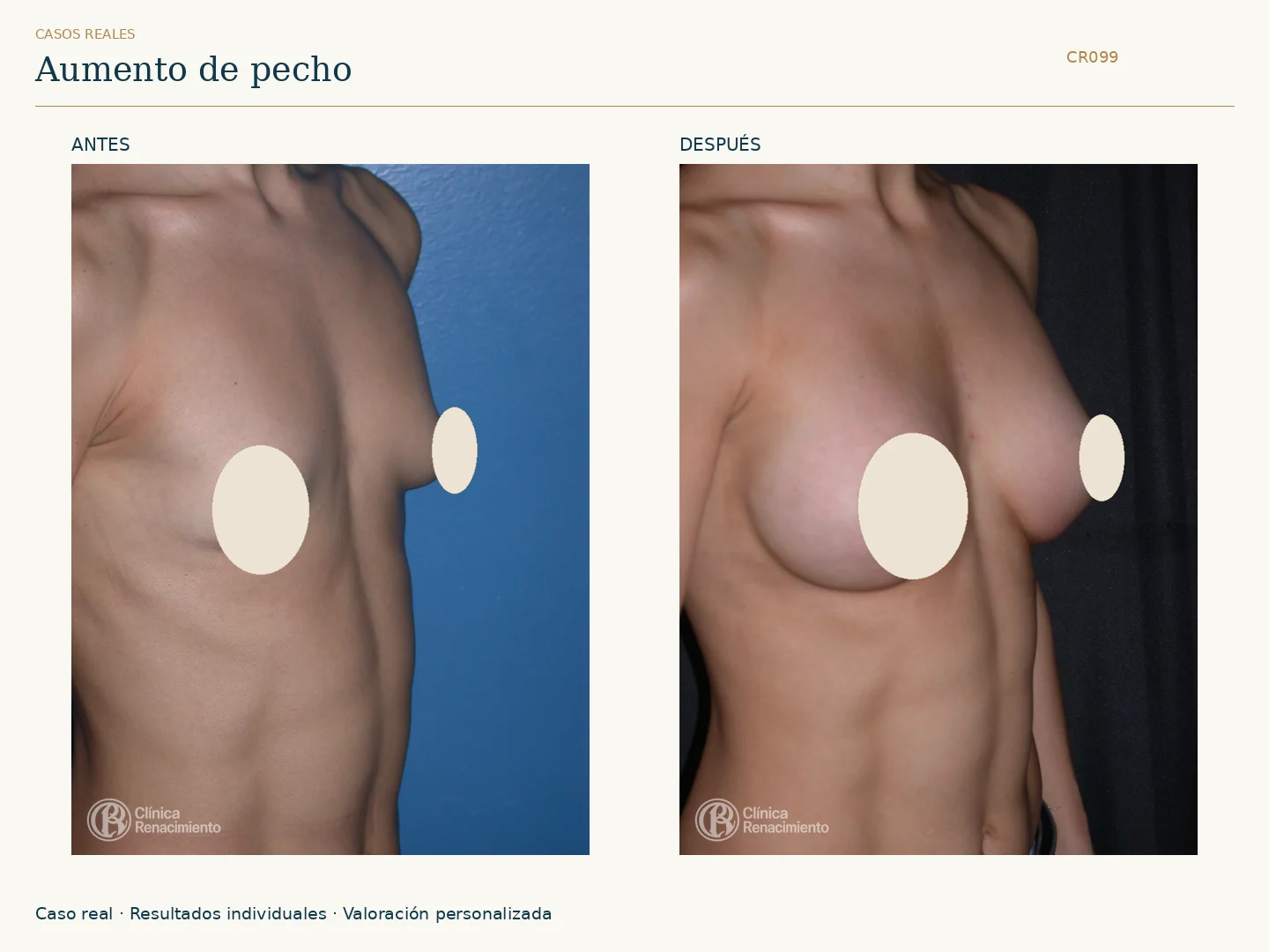 Aumento de senos / Mamoplastia de aumento: antes y después, vista oblicua derecha. Clínica Renacimiento Marbella.