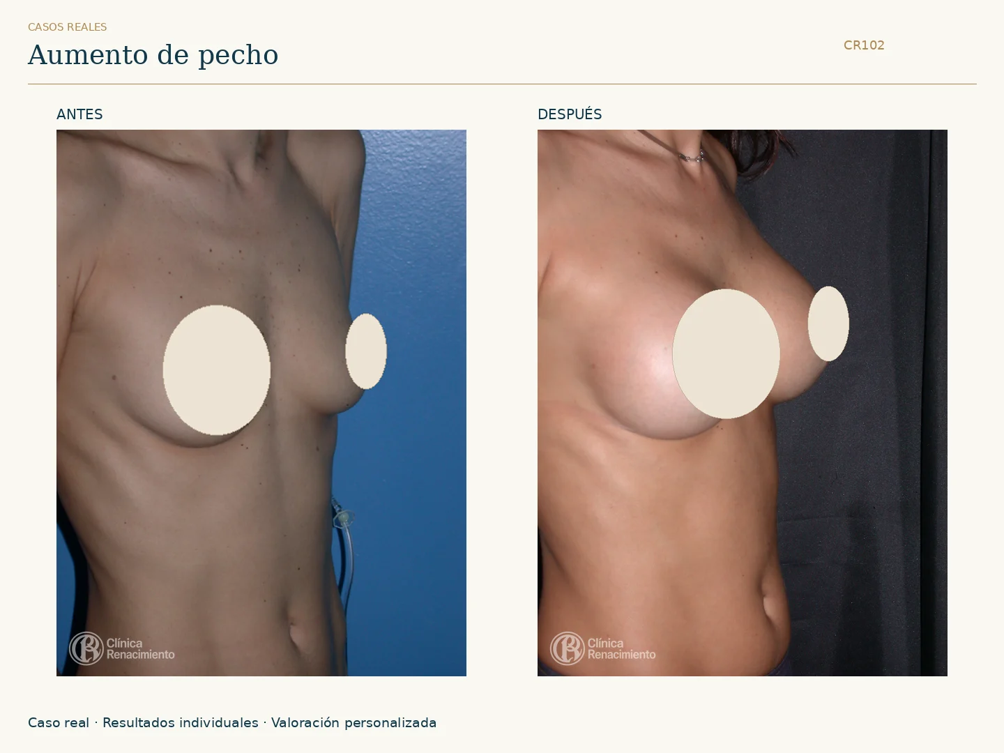 Aumento de senos / Mamoplastia de aumento: antes y después, vista oblicua derecha. Clínica Renacimiento Marbella.