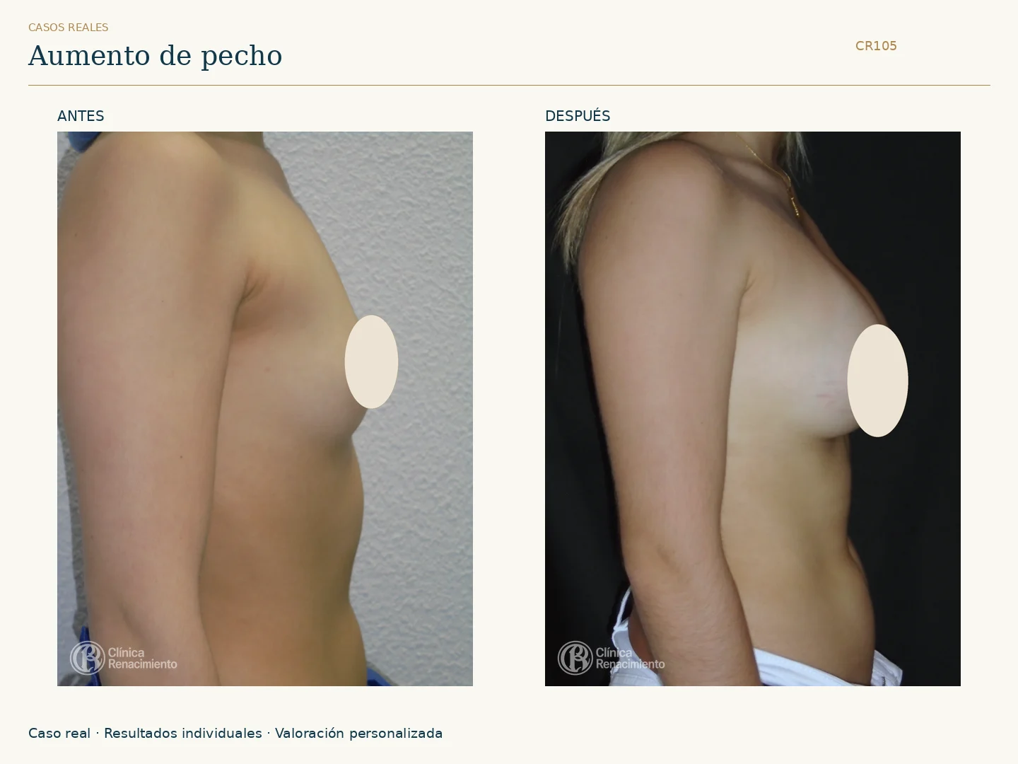 Aumento de senos / Mamoplastia de aumento: antes y después, vista perfil derecho. Clínica Renacimiento Marbella.