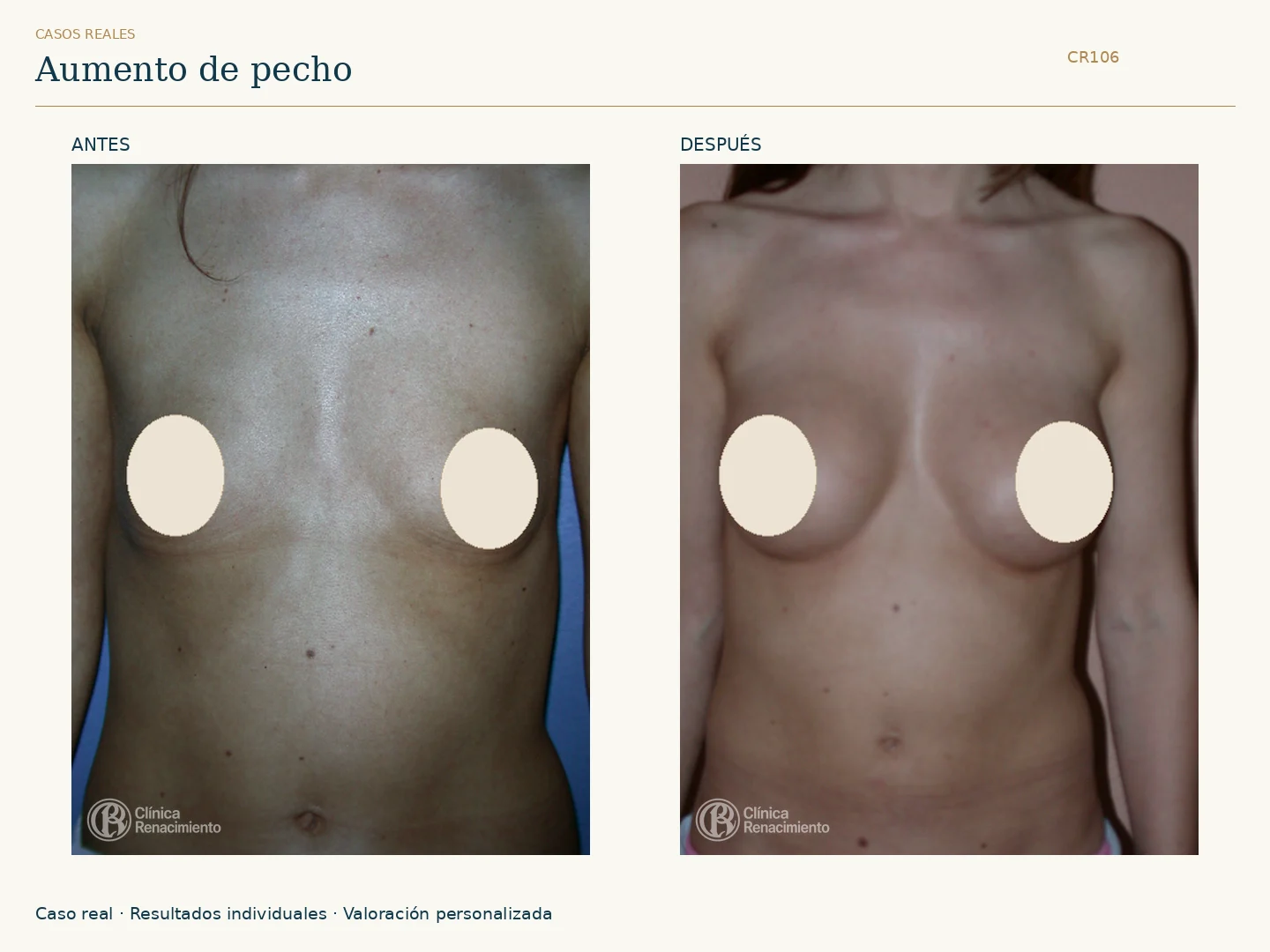 Aumento de senos / Mamoplastia de aumento: antes y después, vista frontal. Clínica Renacimiento Marbella.
