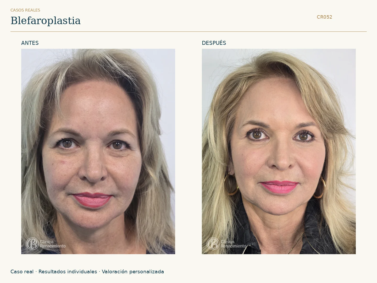 Párpados / Blefaroplastia: antes y después, vista frontal. Clínica Renacimiento Marbella.