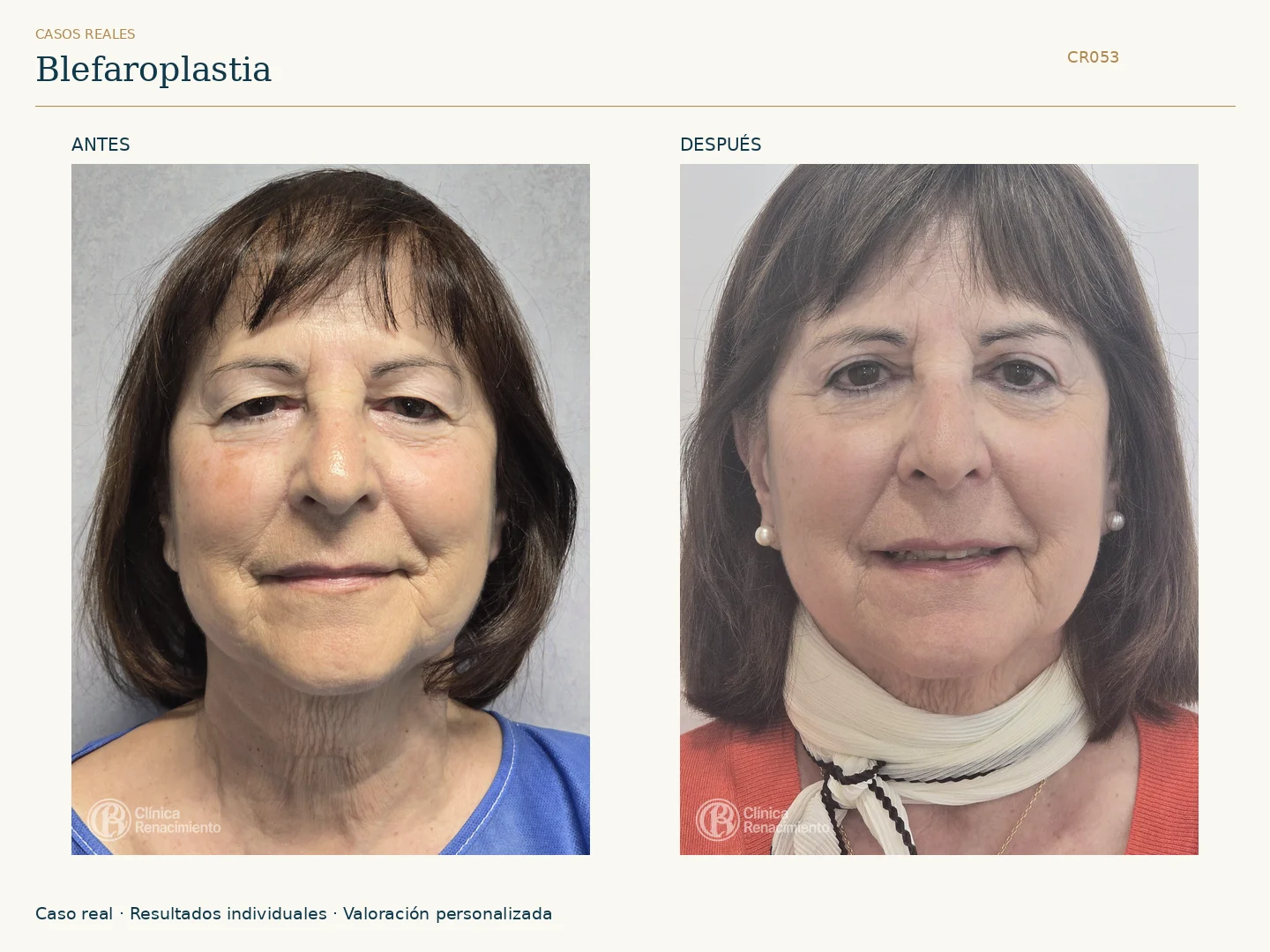 Párpados / Blefaroplastia: antes y después, vista frontal. Clínica Renacimiento Marbella.