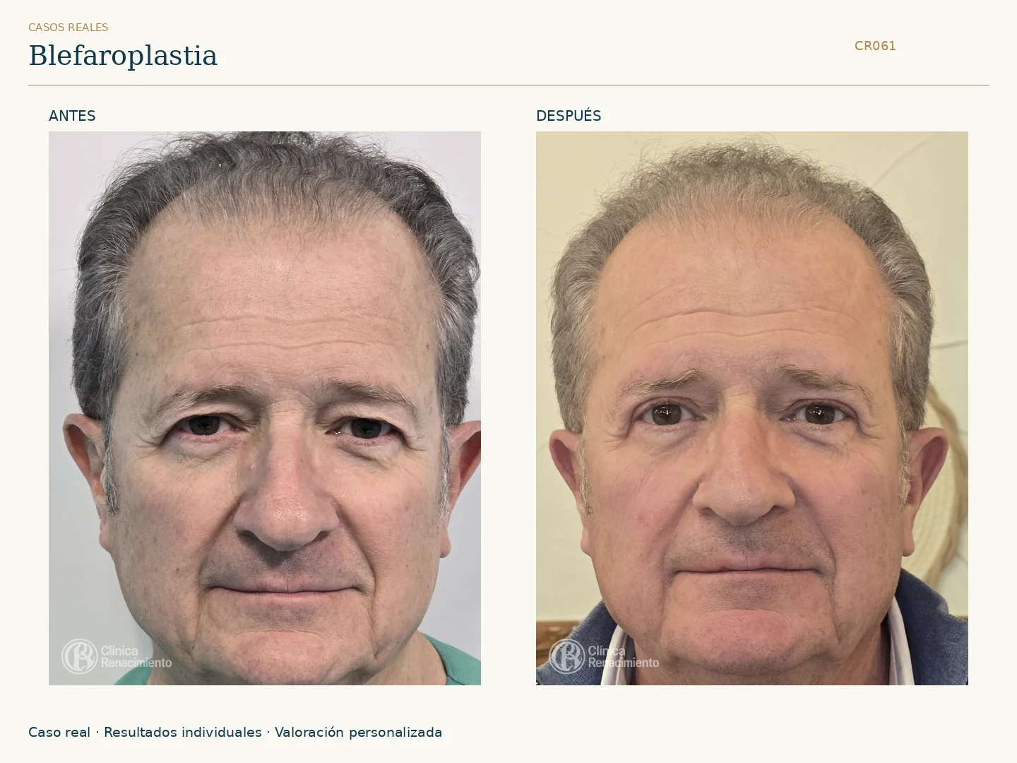 Párpados / Blefaroplastia: antes y después, vista frontal. Clínica Renacimiento Marbella.