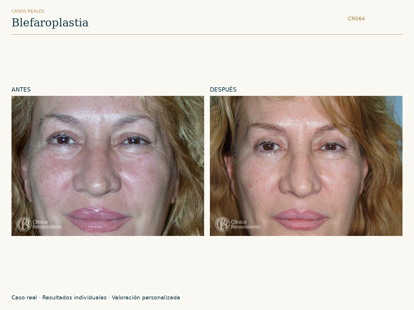 Párpados / Blefaroplastia: antes y después, vista frontal. Clínica Renacimiento Marbella.