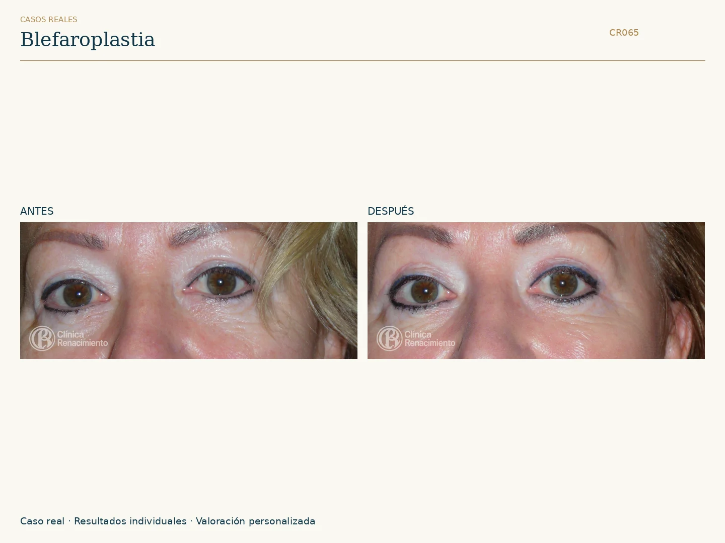 Párpados / Blefaroplastia: antes y después, vista frontal. Clínica Renacimiento Marbella.