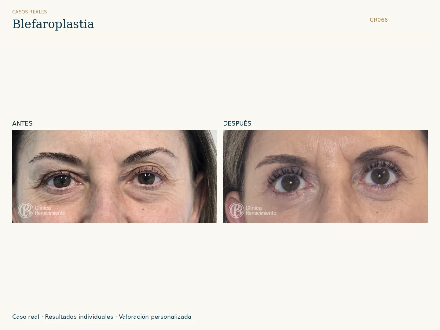 Párpados / Blefaroplastia: antes y después, vista frontal. Clínica Renacimiento Marbella.