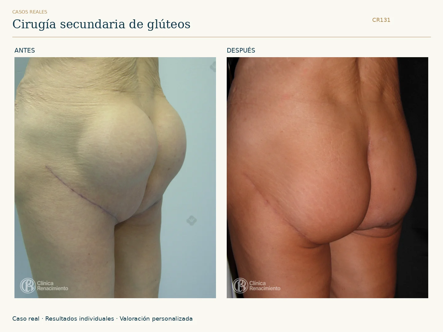 Valoración y cirugía secundaria: antes y después, vista oblicua. Clínica Renacimiento Marbella.