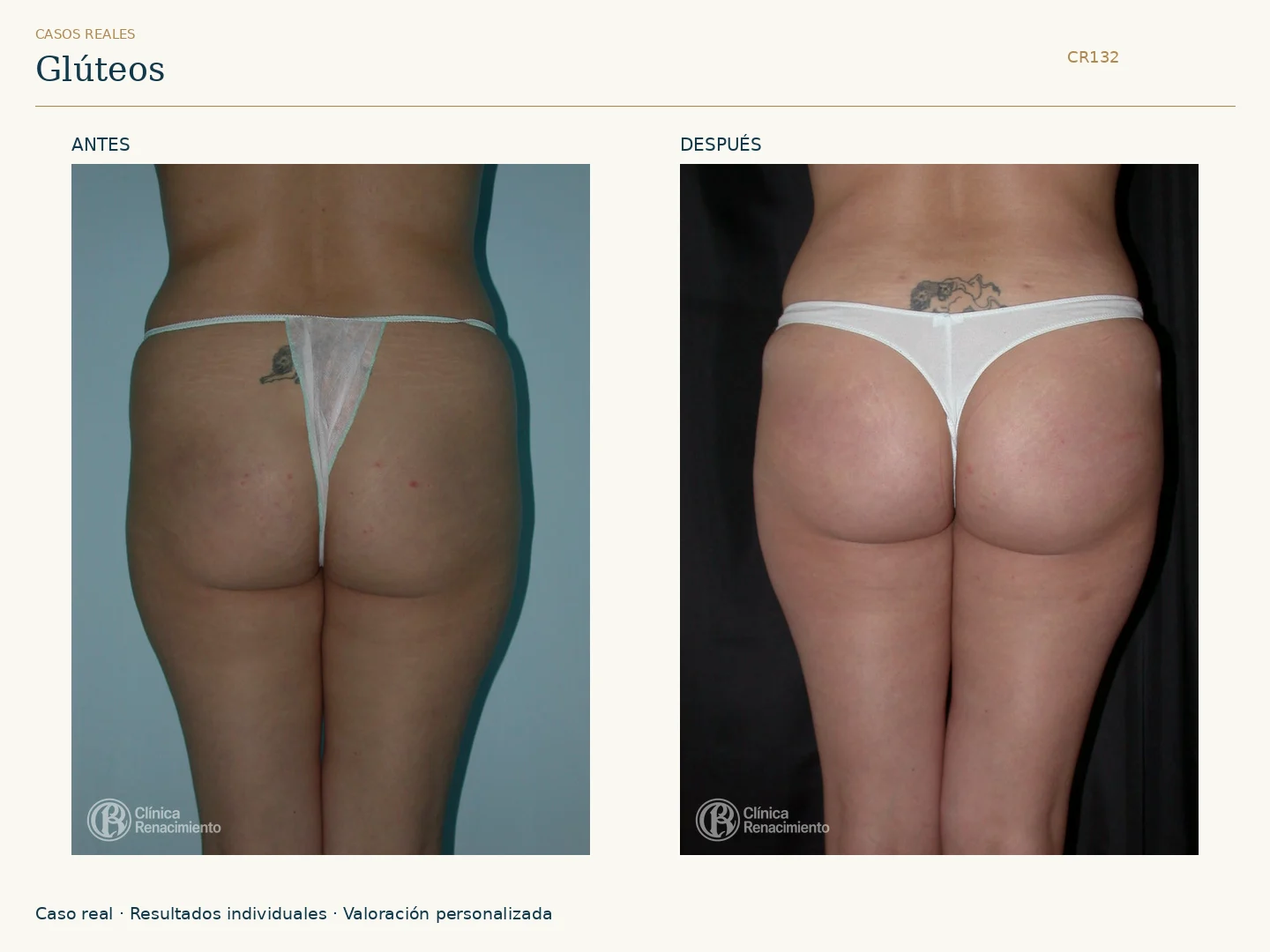 Glúteos / Prótesis de glúteos: antes y después, vista posterior. Clínica Renacimiento Marbella.