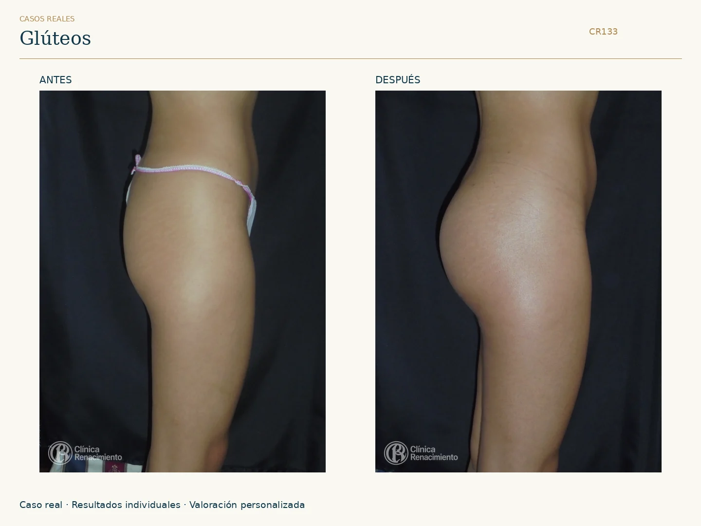 Glúteos / Prótesis de glúteos: antes y después, vista perfil. Clínica Renacimiento Marbella.