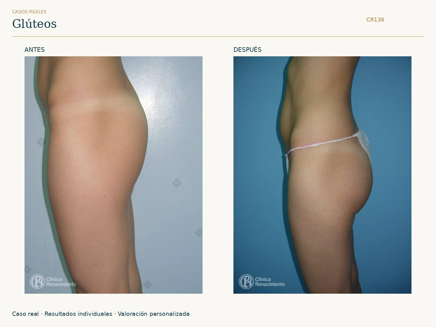 Glúteos / Prótesis de glúteos: antes y después, vista perfil derecho. Clínica Renacimiento Marbella.