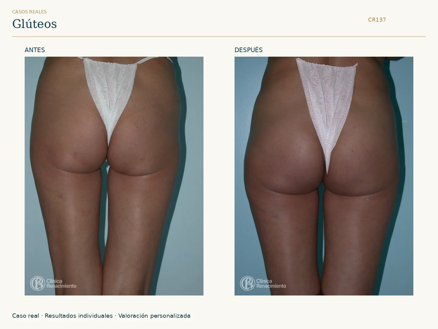 Glúteos / Prótesis de glúteos: antes y después, vista posterior. Clínica Renacimiento Marbella.