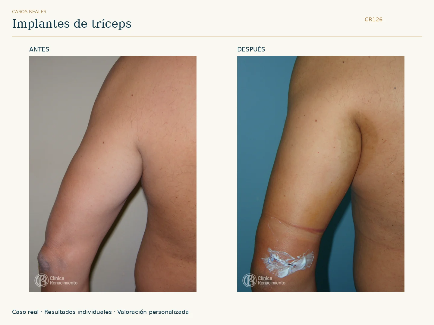 Tríceps / Prótesis de tríceps: antes y después, vista posterior brazo. Clínica Renacimiento Marbella.