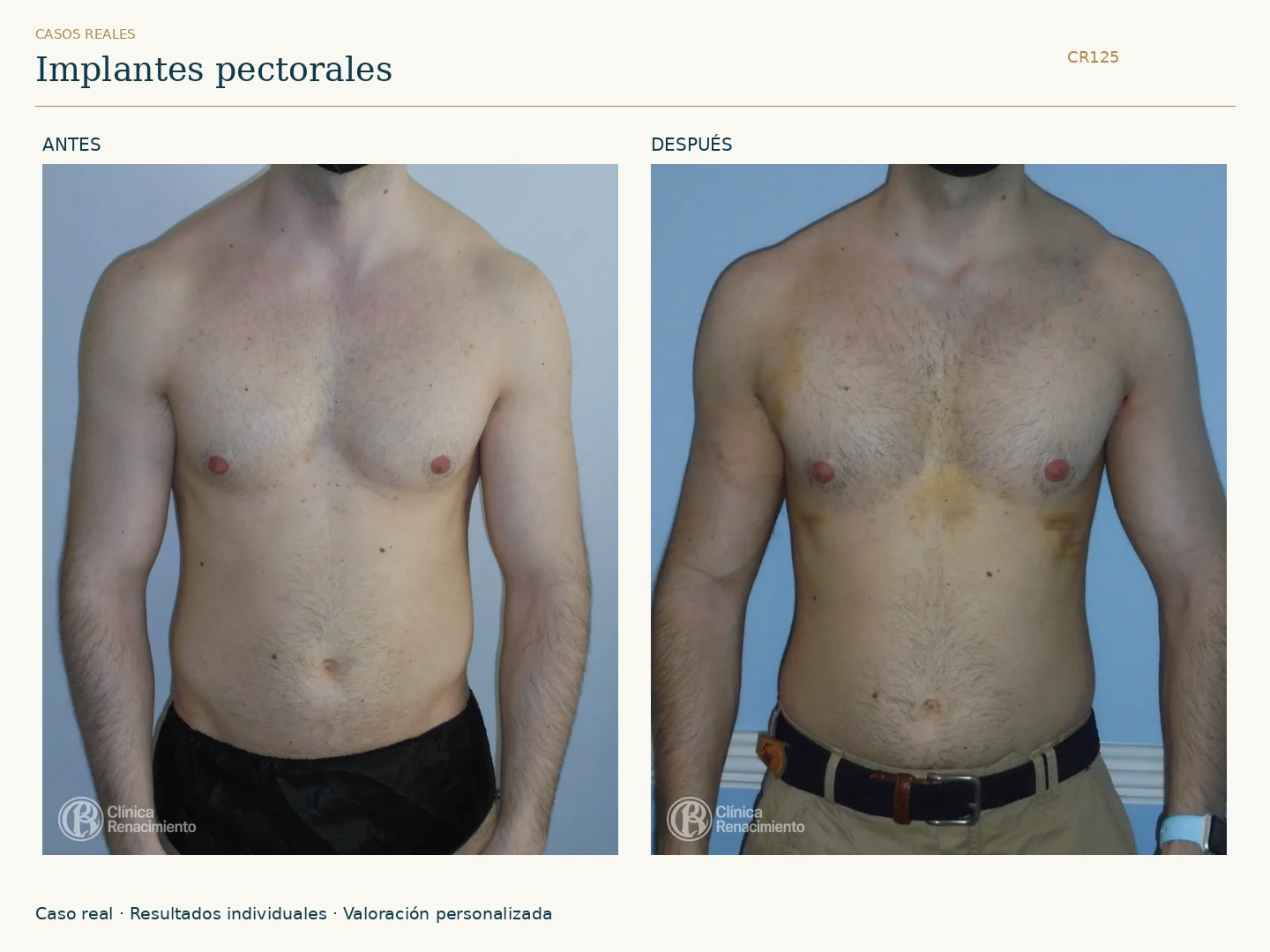 Prótesis de Pectorales: antes y después, vista frontal. Clínica Renacimiento Marbella.