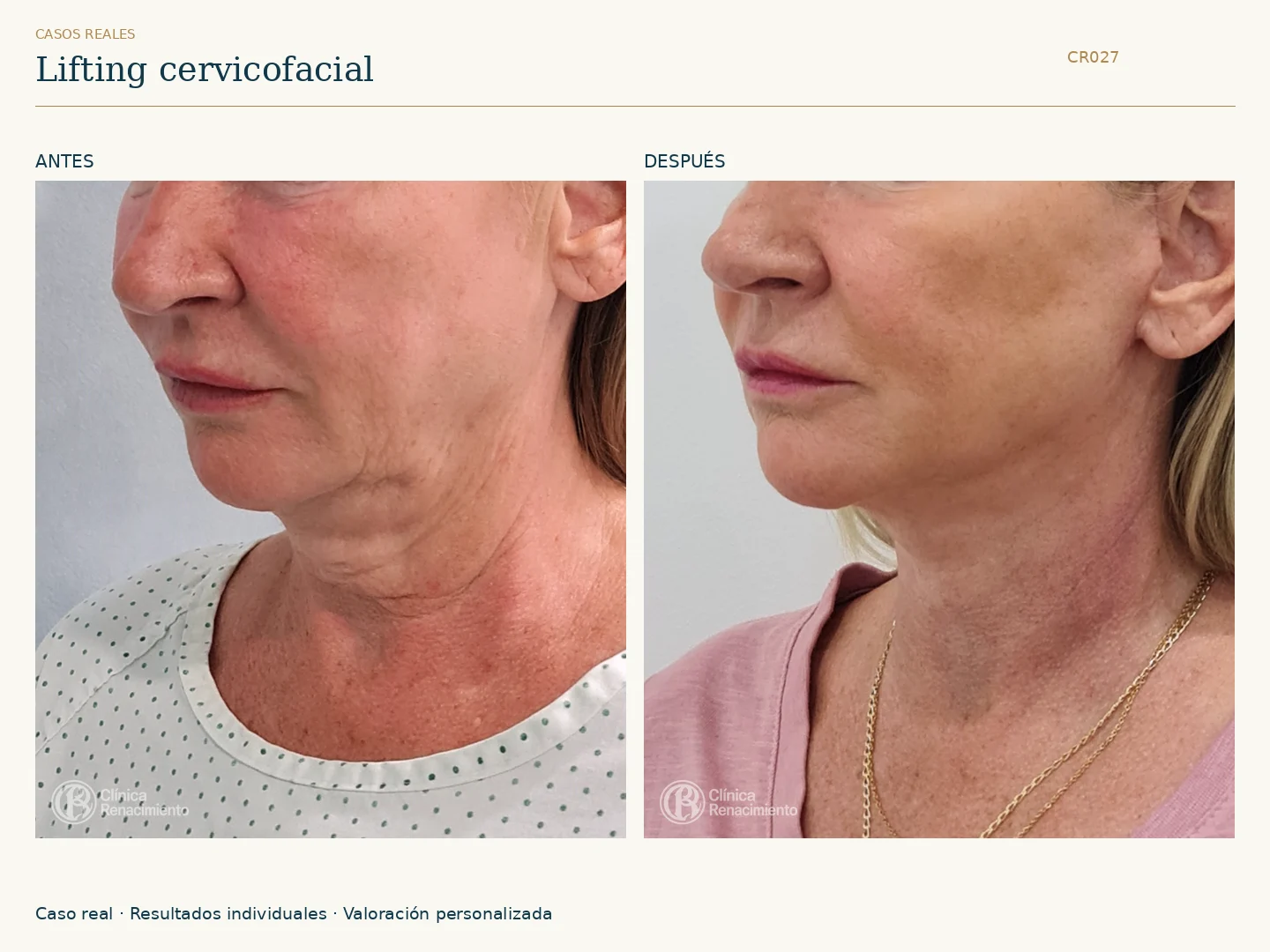 Lifting facial / Ritidectomía: antes y después, vista oblicua izquierda. Clínica Renacimiento Marbella.