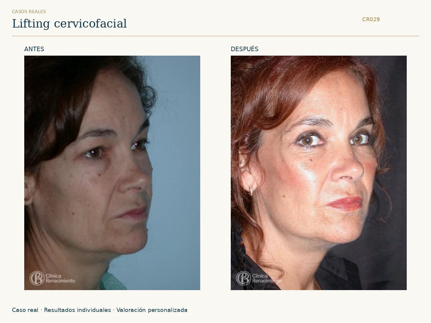 Pómulos / Malarplastia: antes y después, vista oblicua derecha pomulos. Clínica Renacimiento Marbella.