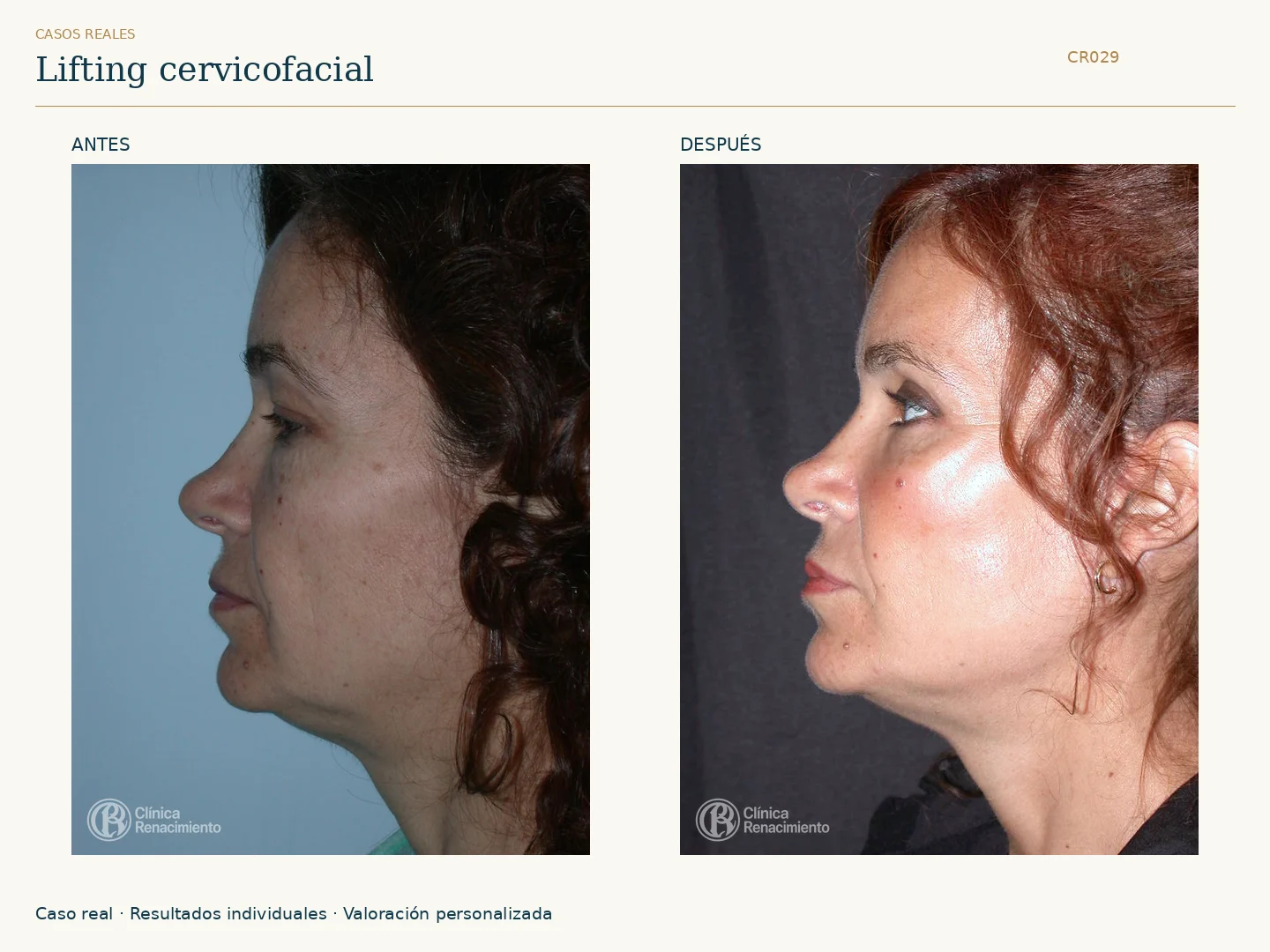 Lifting facial / Ritidectomía: antes y después, vista perfil izquierdo. Clínica Renacimiento Marbella.