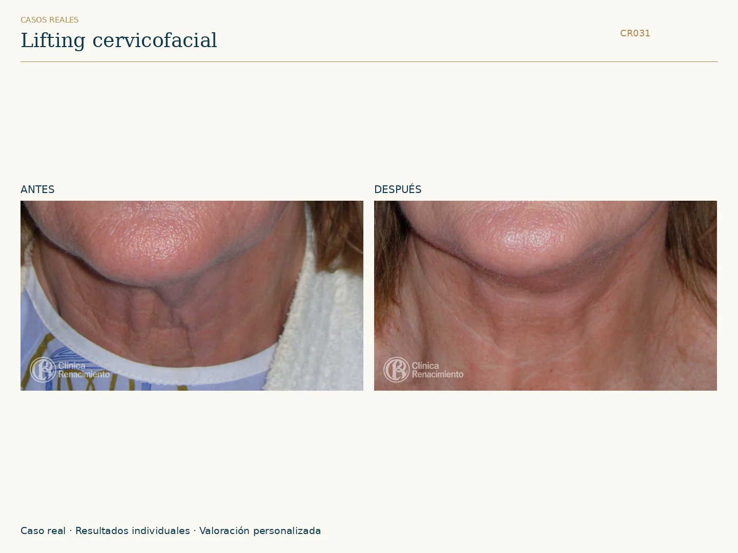 Lifting de cuello / Lifting cervical: antes y después, vista frontal. Clínica Renacimiento Marbella.