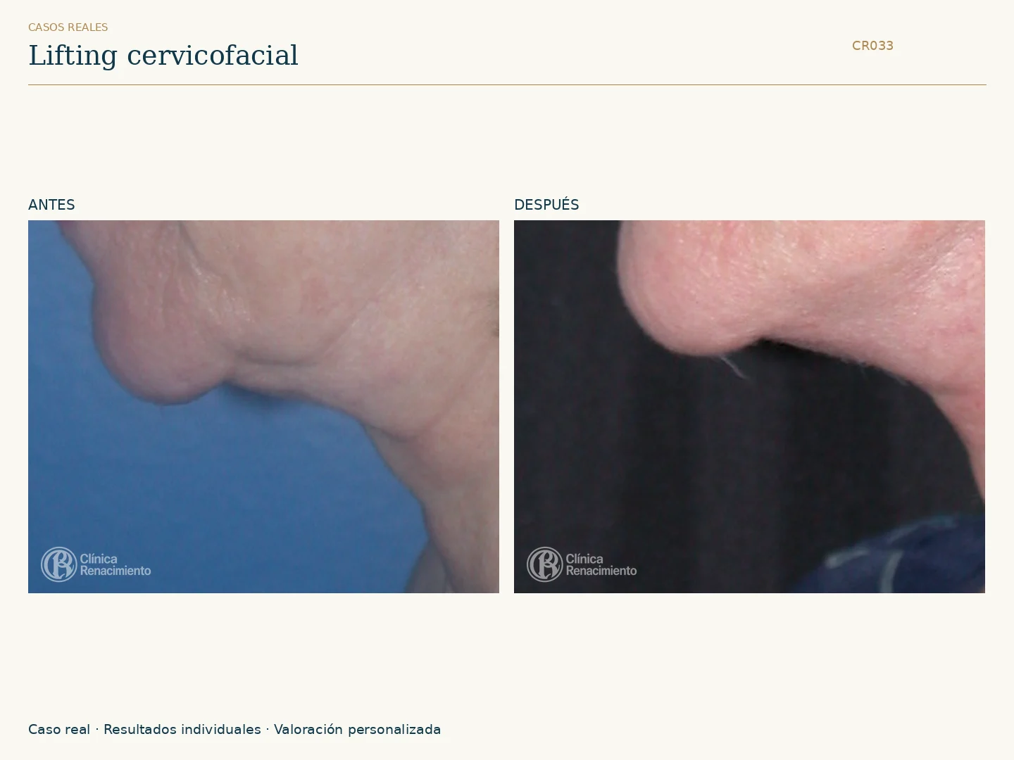 Lifting facial / Ritidectomía: antes y después, vista perfil izquierdo. Clínica Renacimiento Marbella.