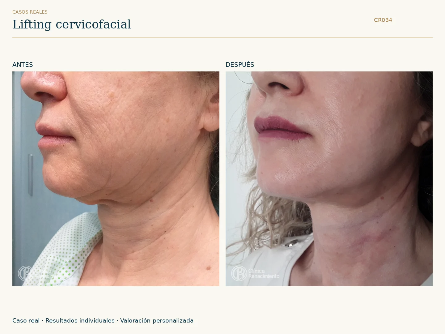 Lifting facial / Ritidectomía: antes y después, vista oblicua izquierda. Clínica Renacimiento Marbella.
