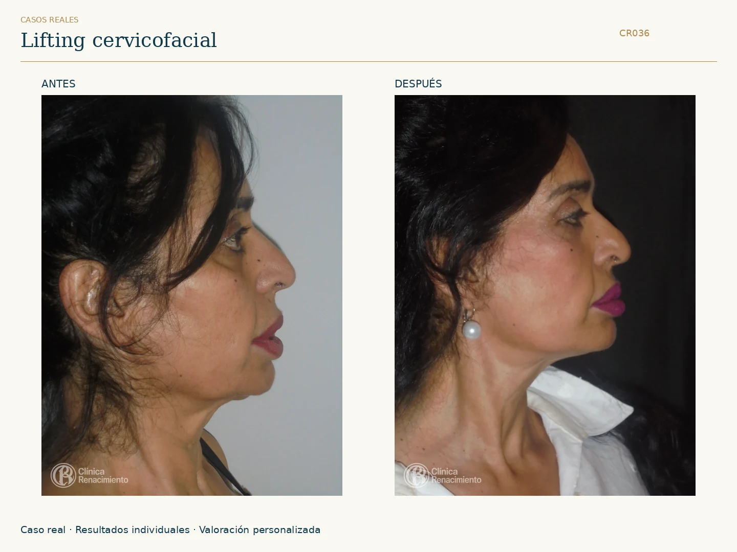 Lifting facial / Ritidectomía: antes y después, vista perfil derecho. Clínica Renacimiento Marbella.