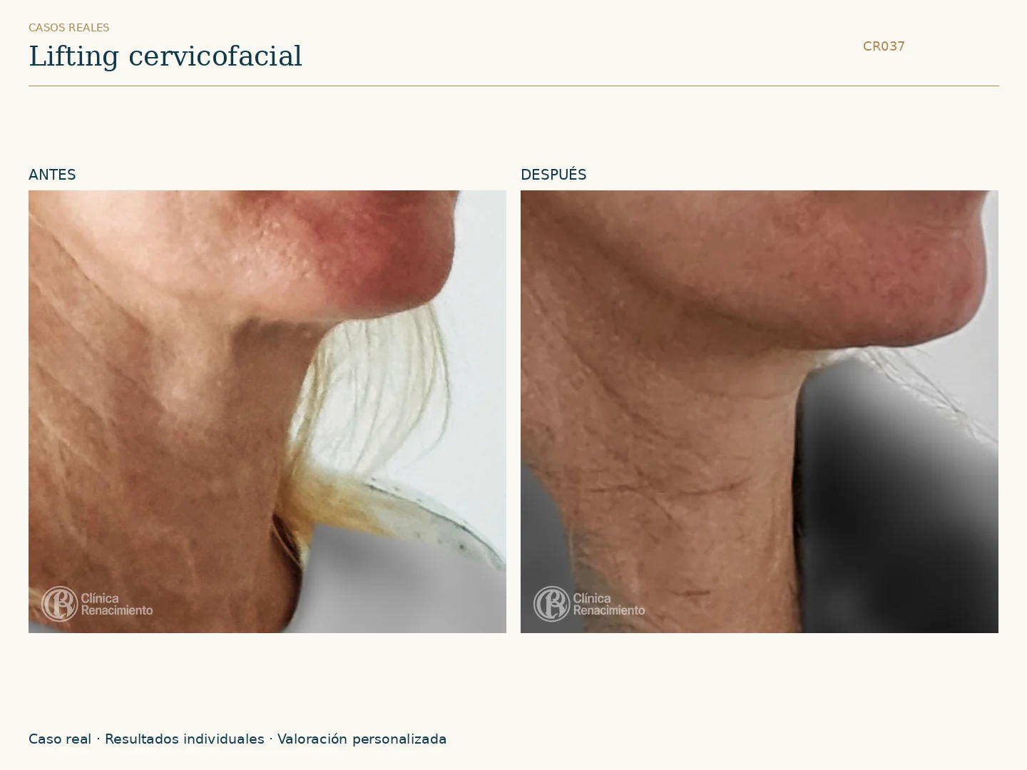 Lifting facial / Ritidectomía: antes y después, vista oblicua derecha. Clínica Renacimiento Marbella.