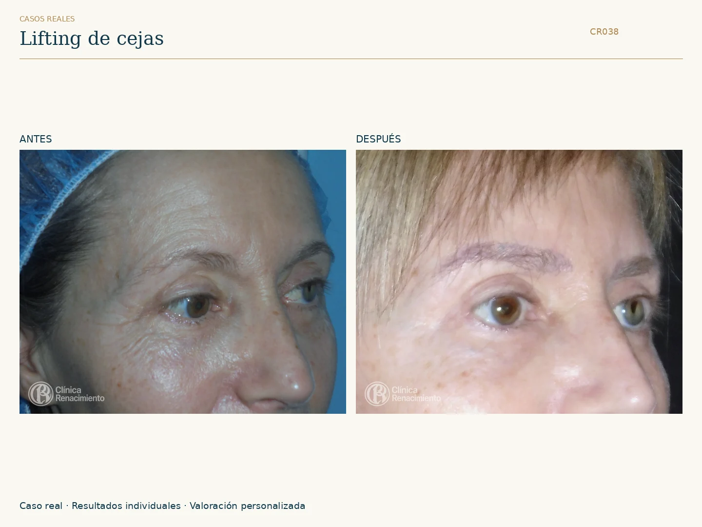 Lifting de cejas / Brow Lift: antes y después, vista oblicua derecha. Clínica Renacimiento Marbella.