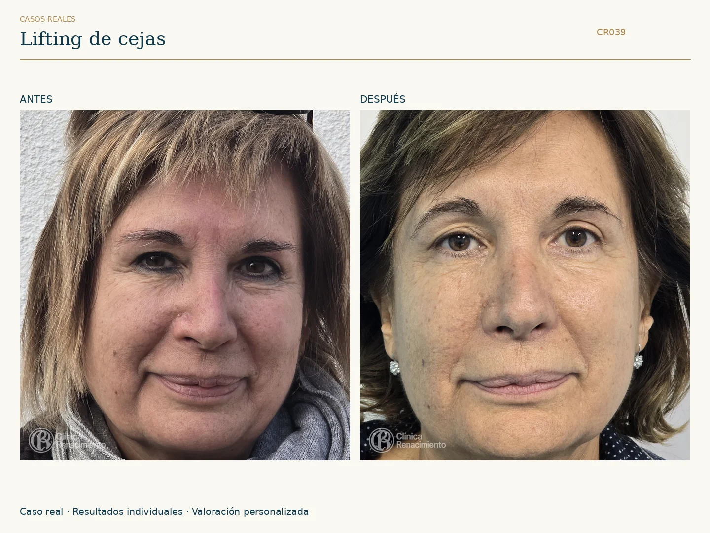 Lifting de cejas / Brow Lift: antes y después, vista frontal. Clínica Renacimiento Marbella.