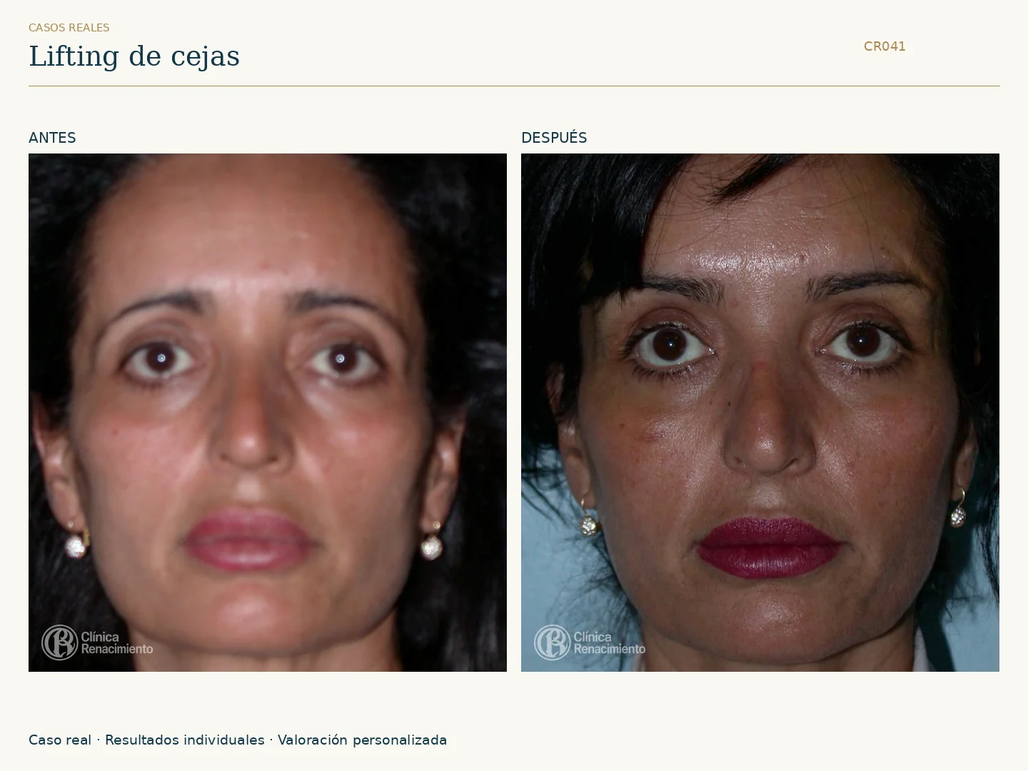Lifting de cejas / Brow Lift: antes y después, vista frontal. Clínica Renacimiento Marbella.