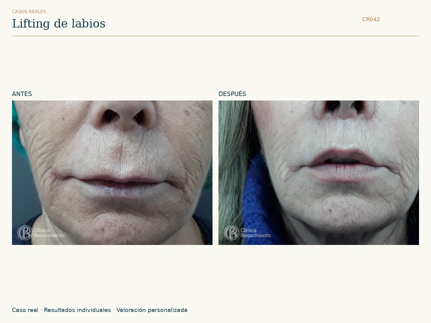 Lifting de labios / Lip Lift: antes y después, vista frontal. Clínica Renacimiento Marbella.
