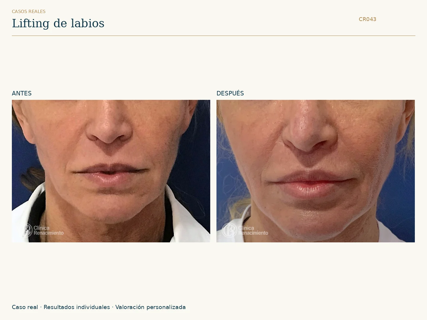 Lifting de labios / Lip Lift: antes y después, vista frontal. Clínica Renacimiento Marbella.
