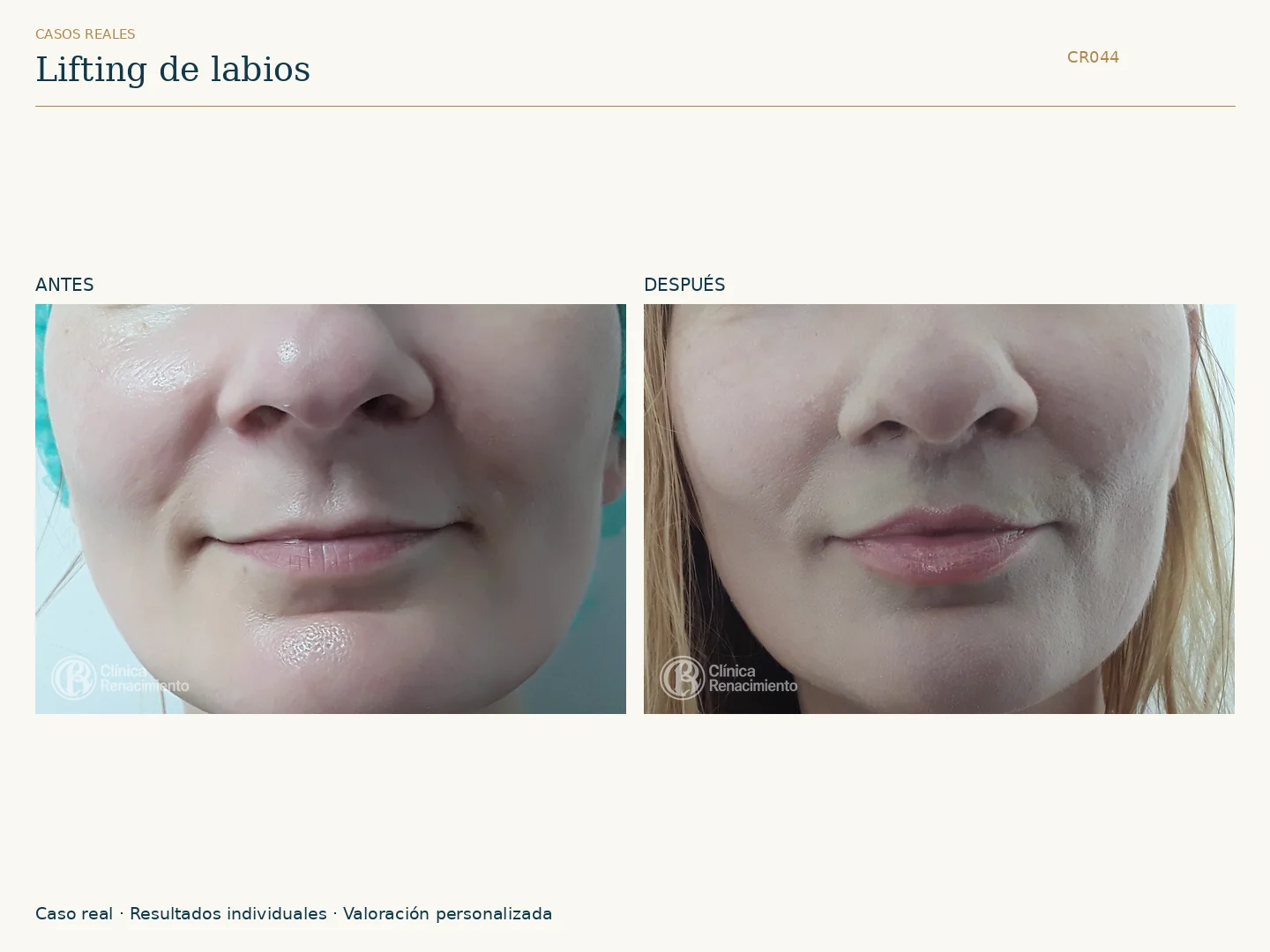 Lifting de labios / Lip Lift: antes y después, vista frontal. Clínica Renacimiento Marbella.