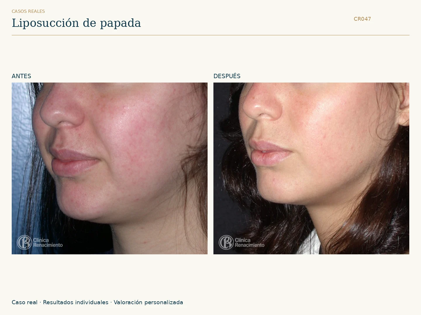 Lipoescultura de Papada: antes y después, vista oblicua izquierda. Clínica Renacimiento Marbella.