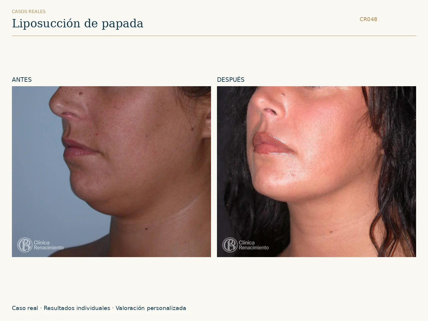 Lipoescultura de Papada: antes y después, vista oblicua izquierda. Clínica Renacimiento Marbella.