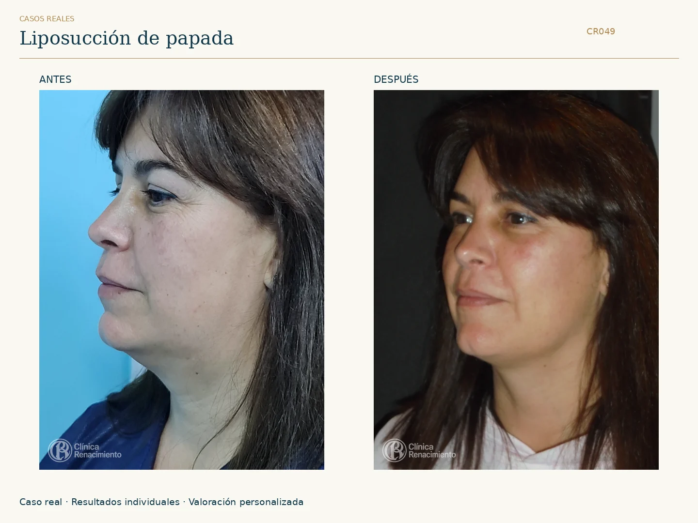Lipoescultura de Papada: antes y después, vista oblicua izquierda. Clínica Renacimiento Marbella.