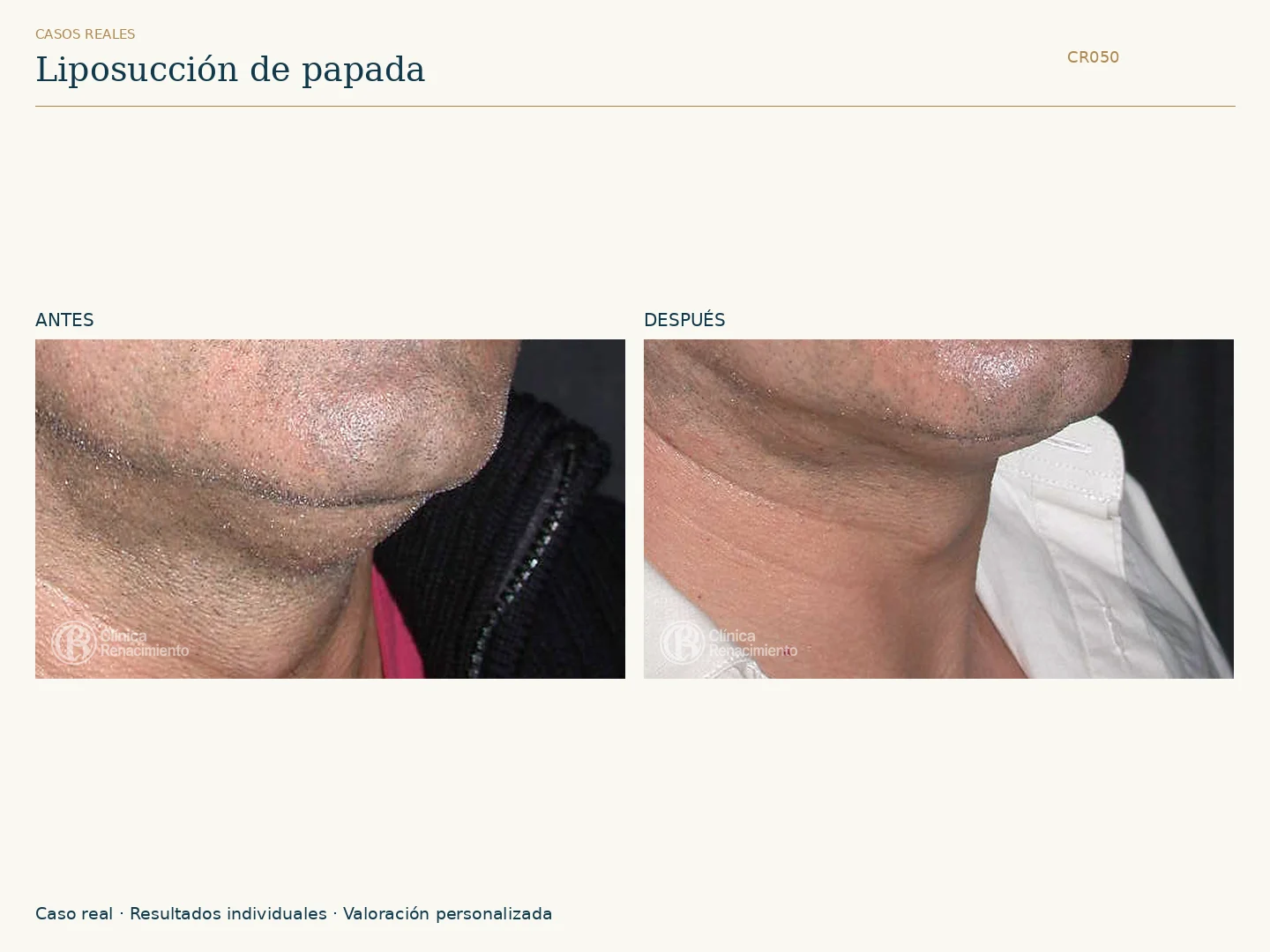 Lipoescultura de Papada: antes y después, vista oblicua derecha. Clínica Renacimiento Marbella.