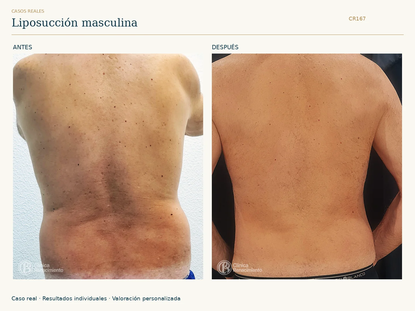 Lipoescultura / Liposucción: antes y después, vista posterior. Clínica Renacimiento Marbella.