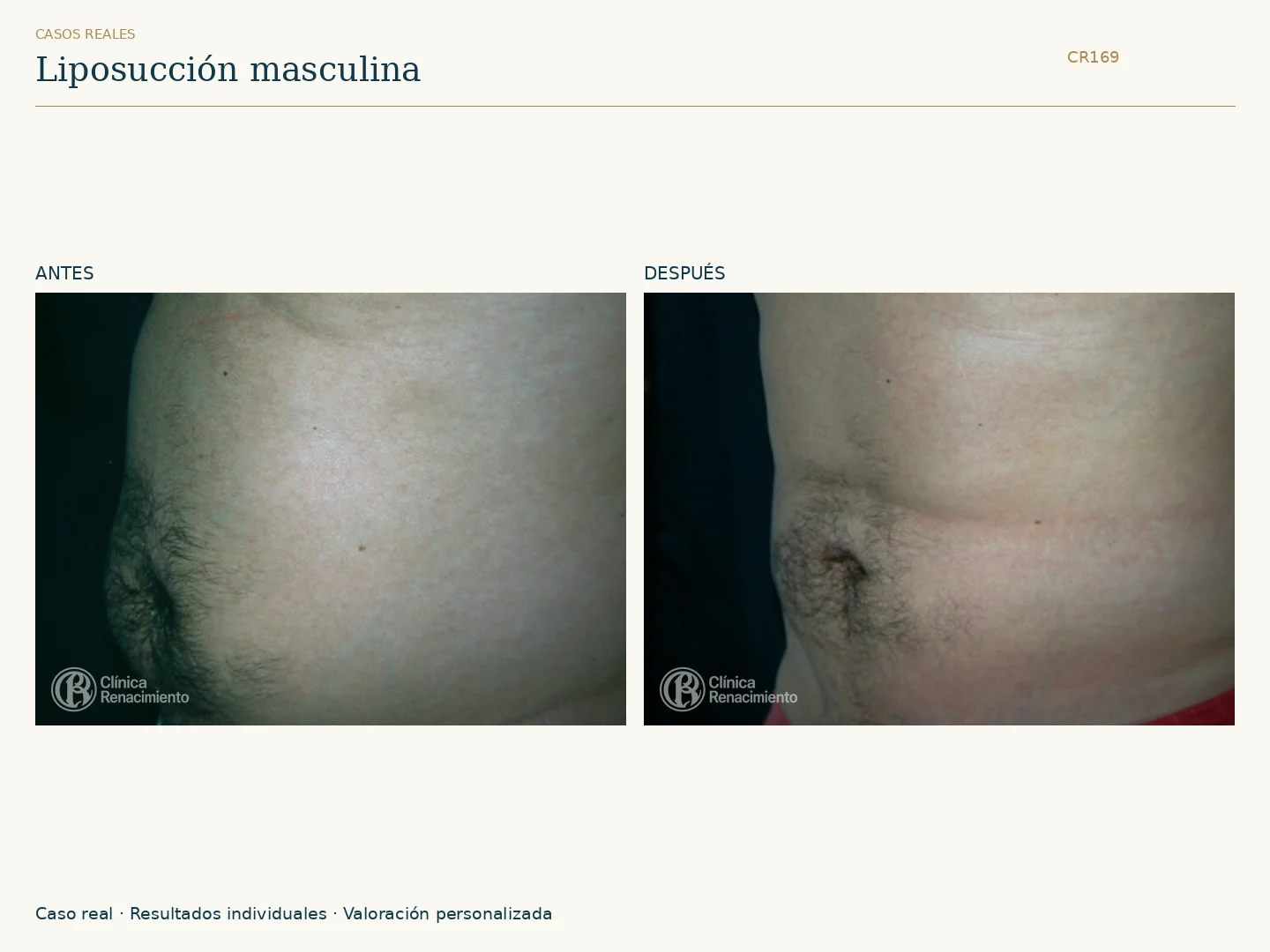 Lipoescultura / Liposucción: antes y después, vista perfil. Clínica Renacimiento Marbella.