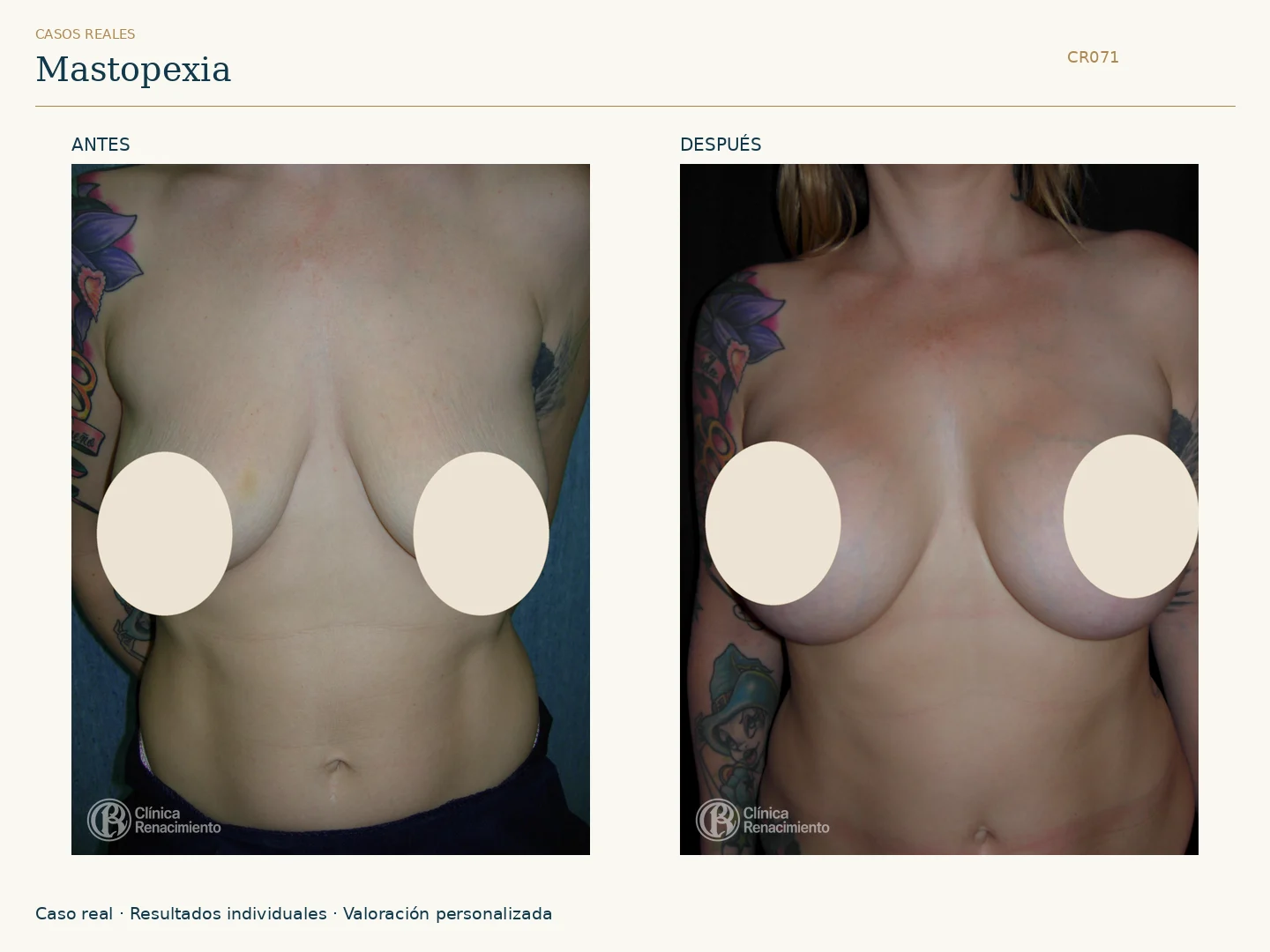 Elevación de senos / Mastopexia: antes y después, vista frontal. Clínica Renacimiento Marbella.