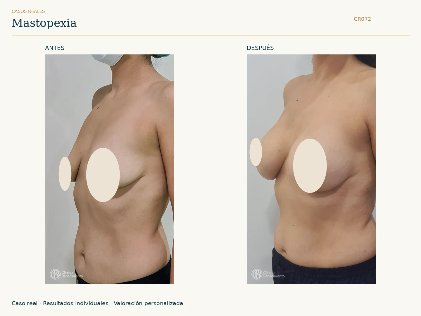 Elevación de senos / Mastopexia: antes y después, vista oblicua izquierda. Clínica Renacimiento Marbella.