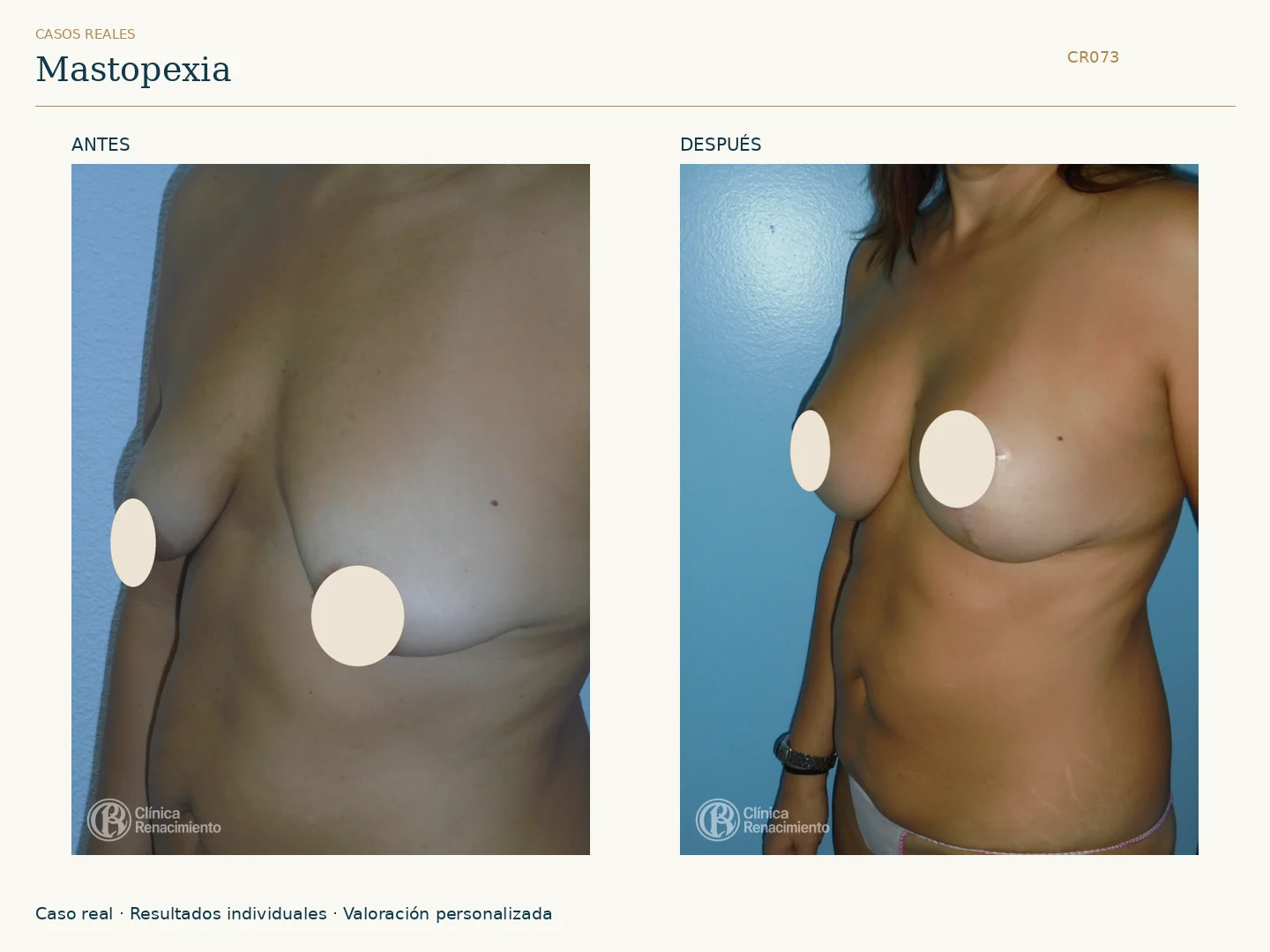 Elevación de senos / Mastopexia: antes y después, vista oblicua izquierda. Clínica Renacimiento Marbella.