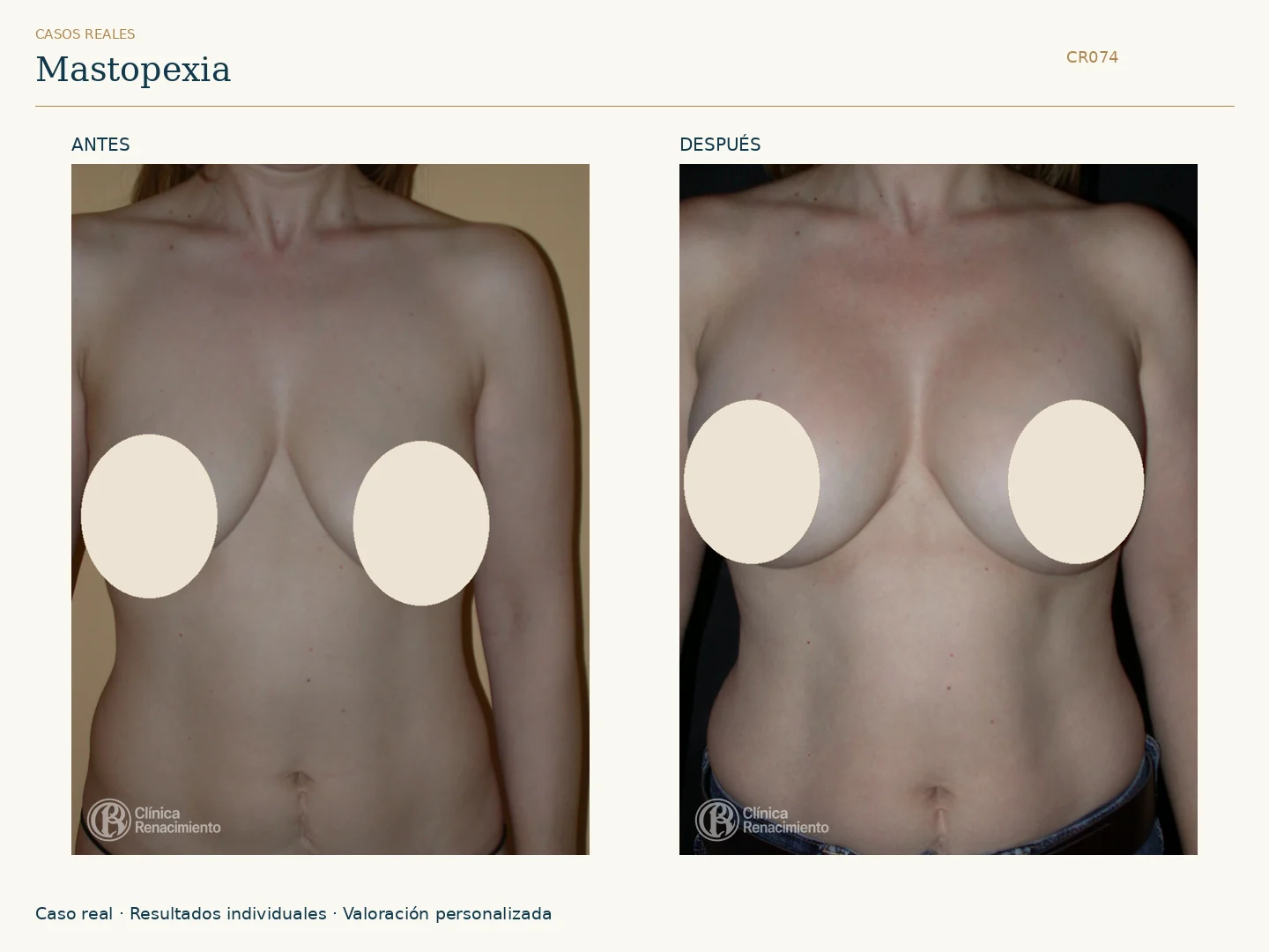 Elevación de senos / Mastopexia: antes y después, vista frontal. Clínica Renacimiento Marbella.