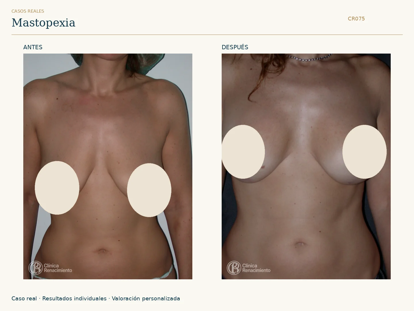 Elevación de senos / Mastopexia: antes y después, vista frontal. Clínica Renacimiento Marbella.