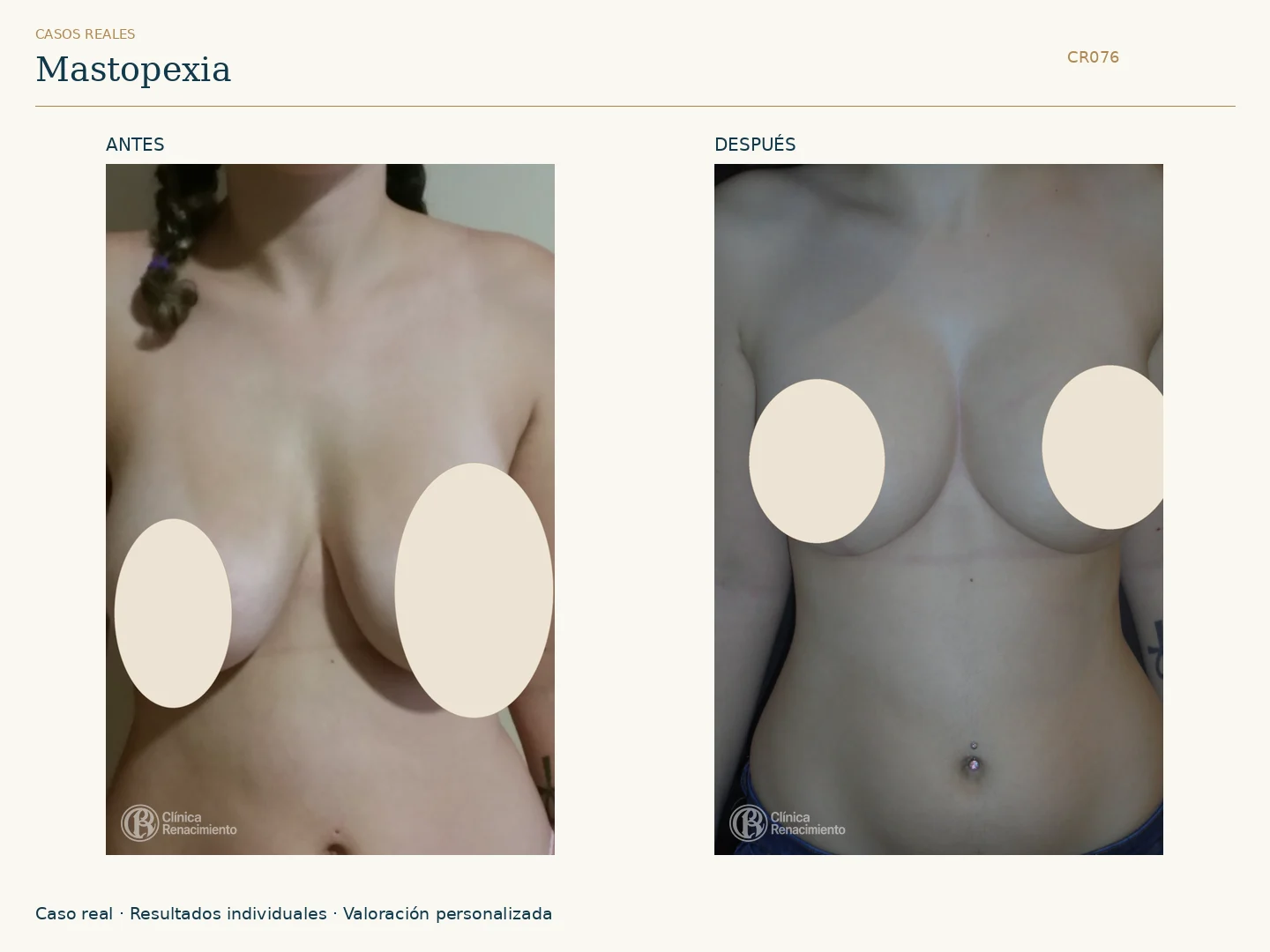 Elevación de senos / Mastopexia: antes y después, vista frontal. Clínica Renacimiento Marbella.