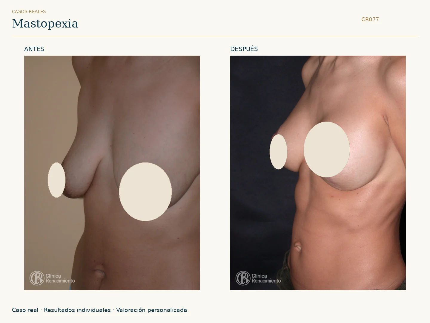 Elevación de senos / Mastopexia: antes y después, vista oblicua izquierda. Clínica Renacimiento Marbella.