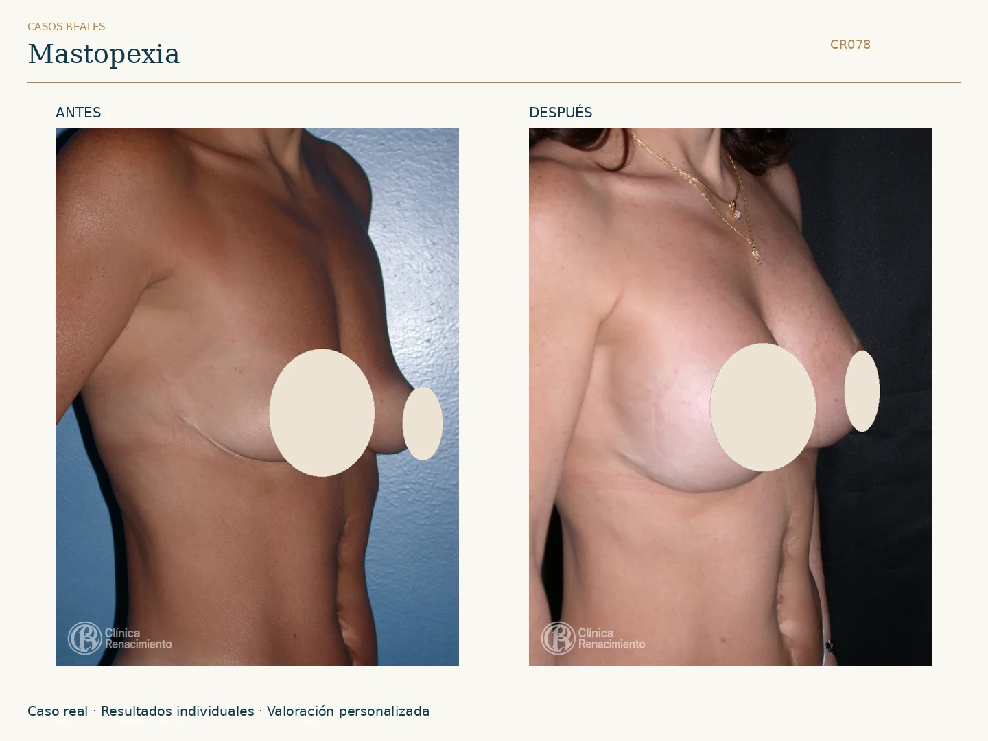 Elevación de senos / Mastopexia: antes y después, vista oblicua derecha. Clínica Renacimiento Marbella.